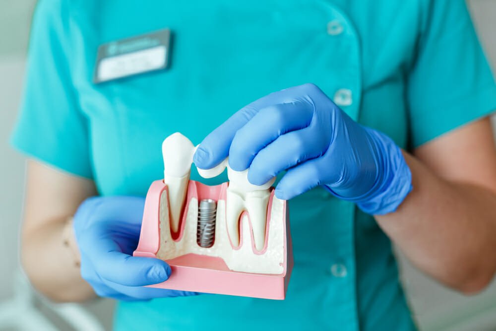 Why Are Dental Implants So Expensive? [+Cheaper Alternatives]